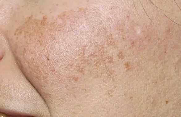Melasma