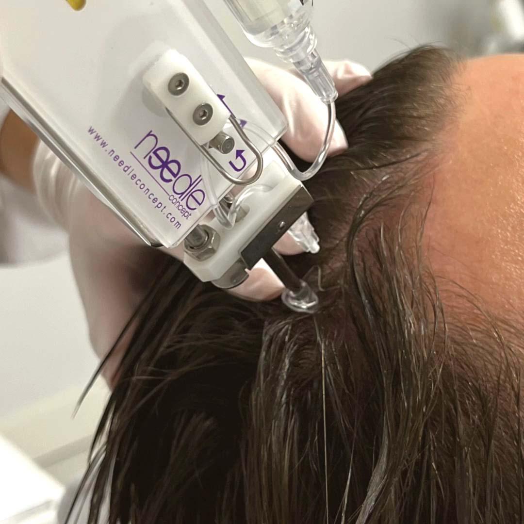 Mesotherapie