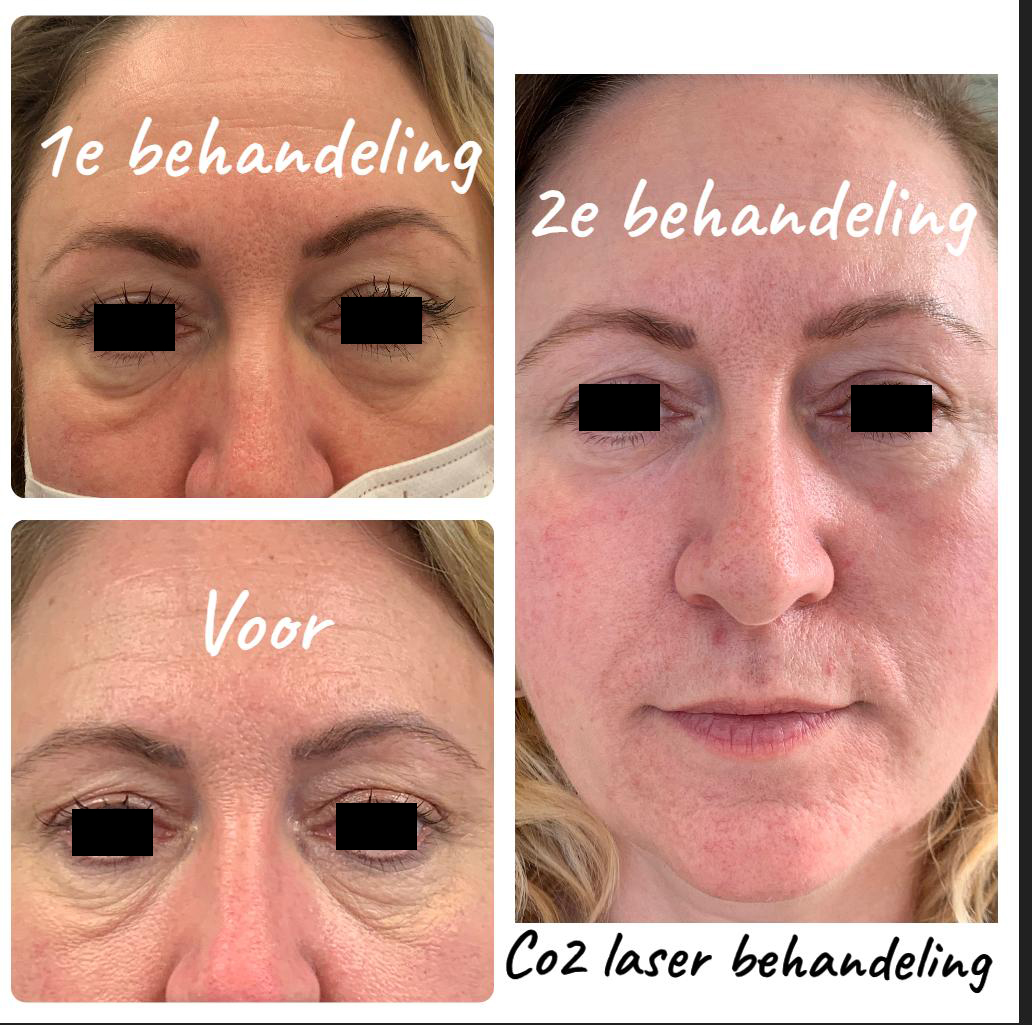 Niet-chirurgische ooglidverstrakking