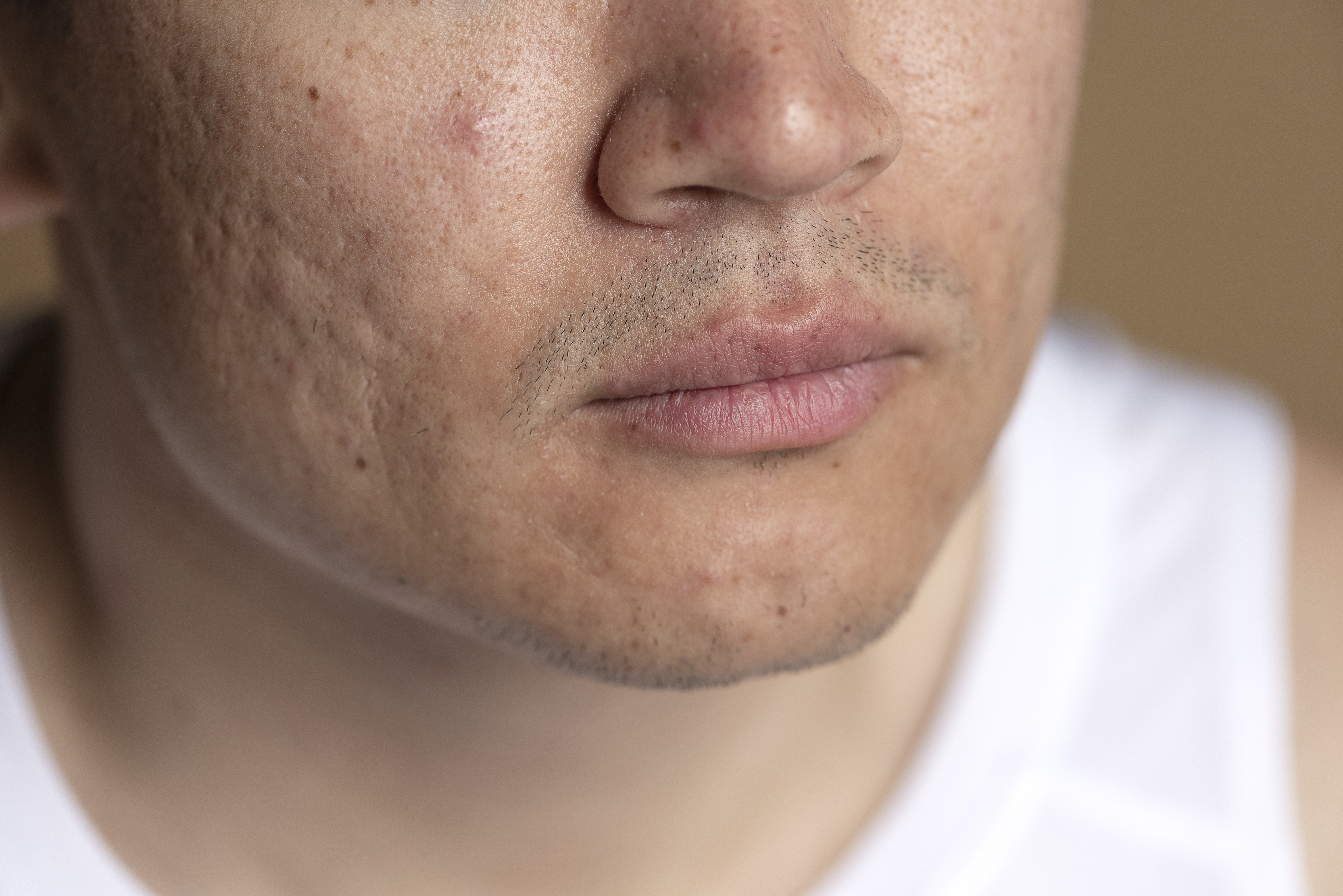 Acne littekens 