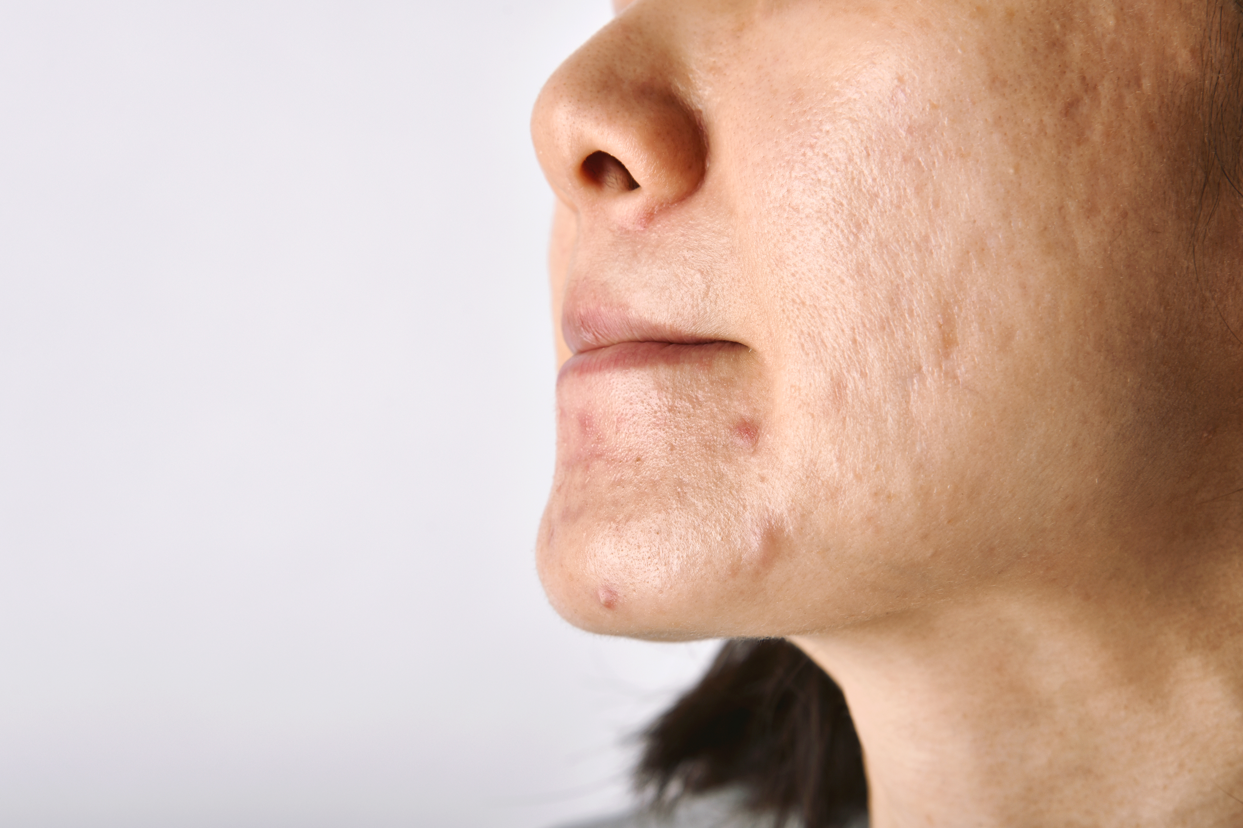Acne littekens 