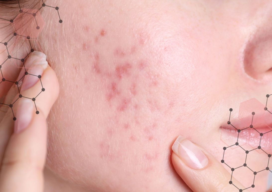 Post inflammatoire erytheem (PIE) 