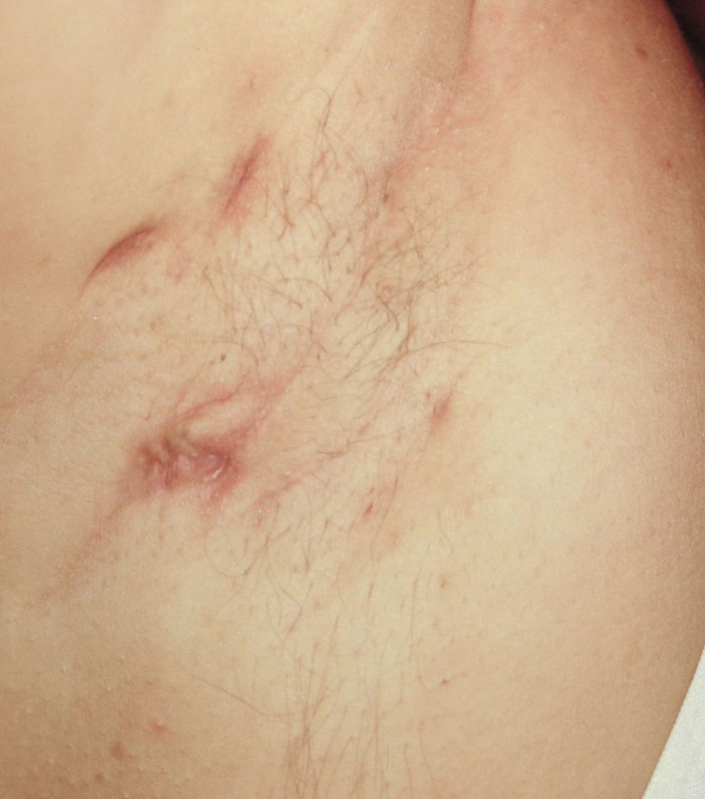 Hidradenitis Suppurativa (HS)