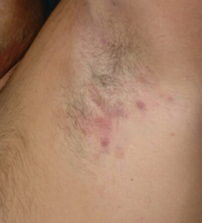Hidradenitis Suppurativa (HS)