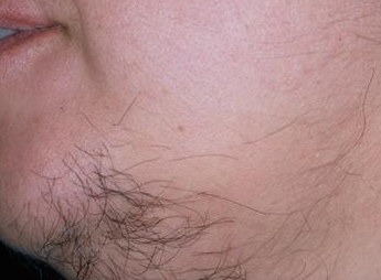 Hirsutisme