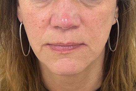 Vaatlaser en IPL bij rosacea