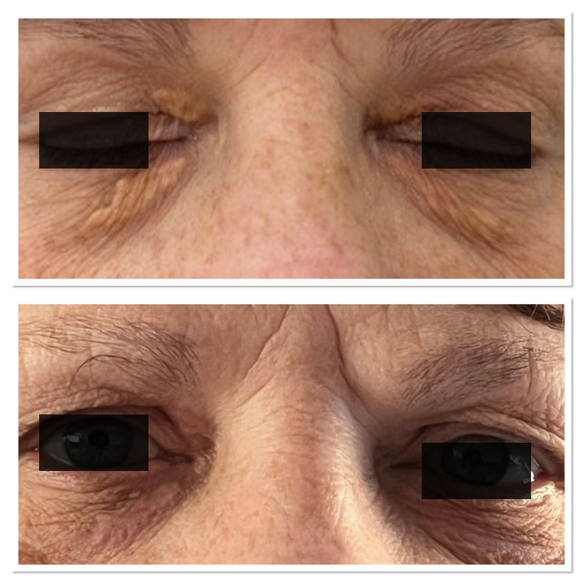 Xanthelasma (Gele bultjes in de ooghoek)