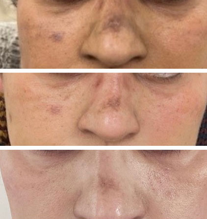 Post-inflammatoire hyperpigmentatie (PIH)