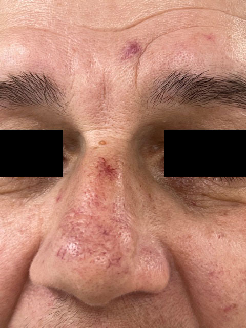 Nd:YAG-laser behandelingen