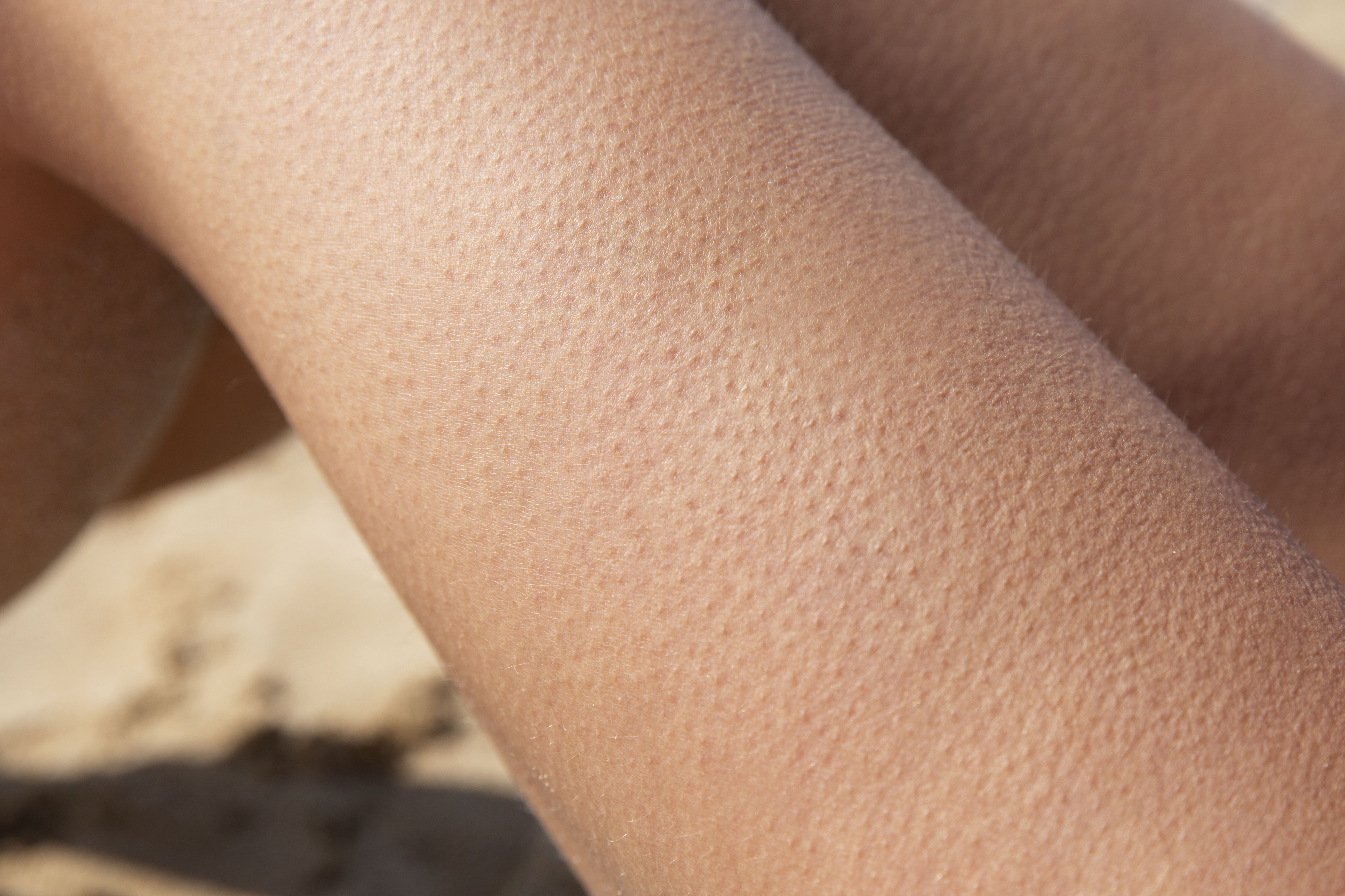 Keratosis Pilaris (Kippenvelhuid)
