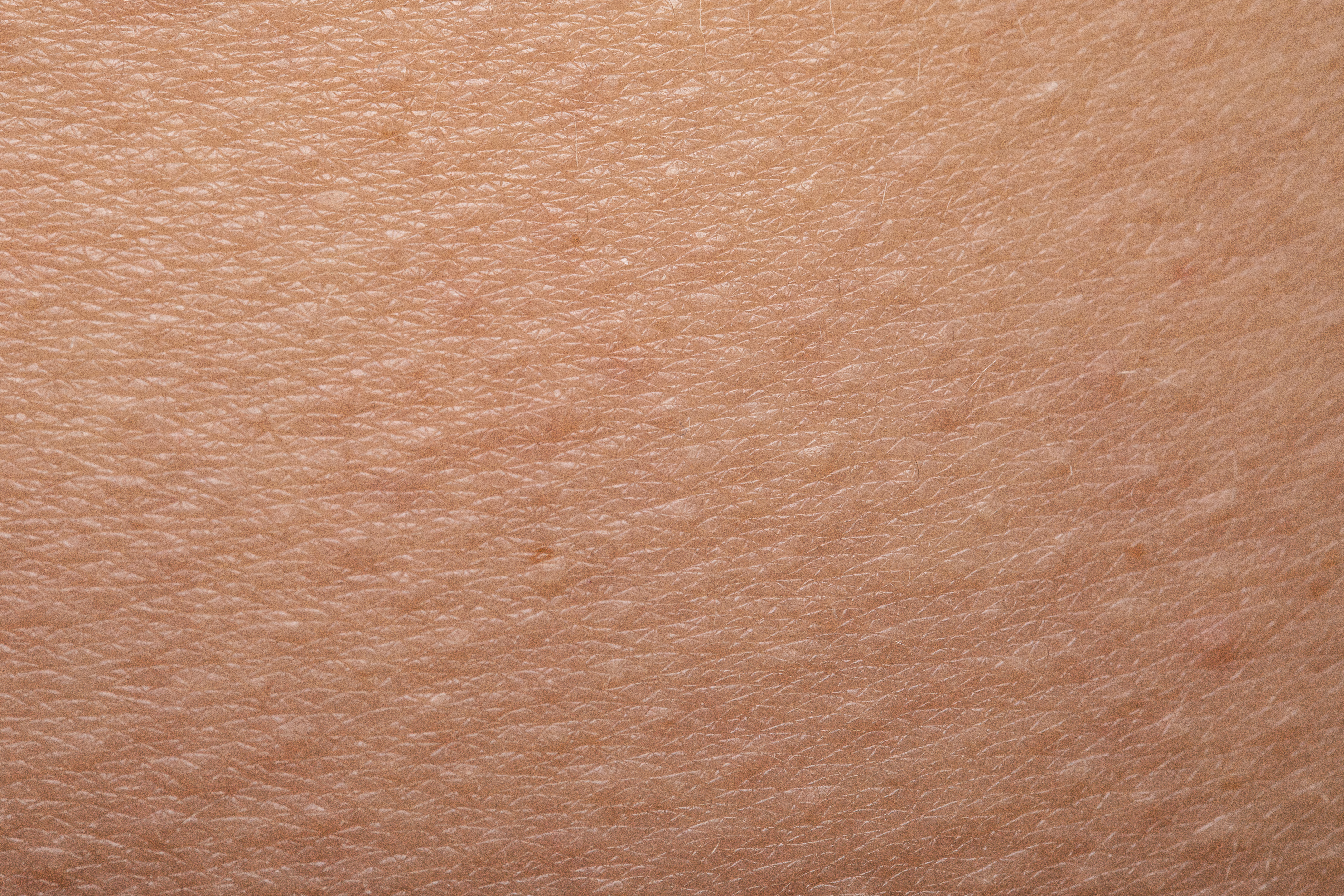Keratosis Pilaris (Kippenvelhuid)
