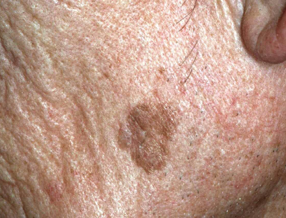 Lentigo solaris (ouderdomsvlekken-levervlekken)