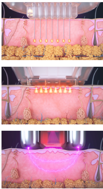 (RF) Microneedling