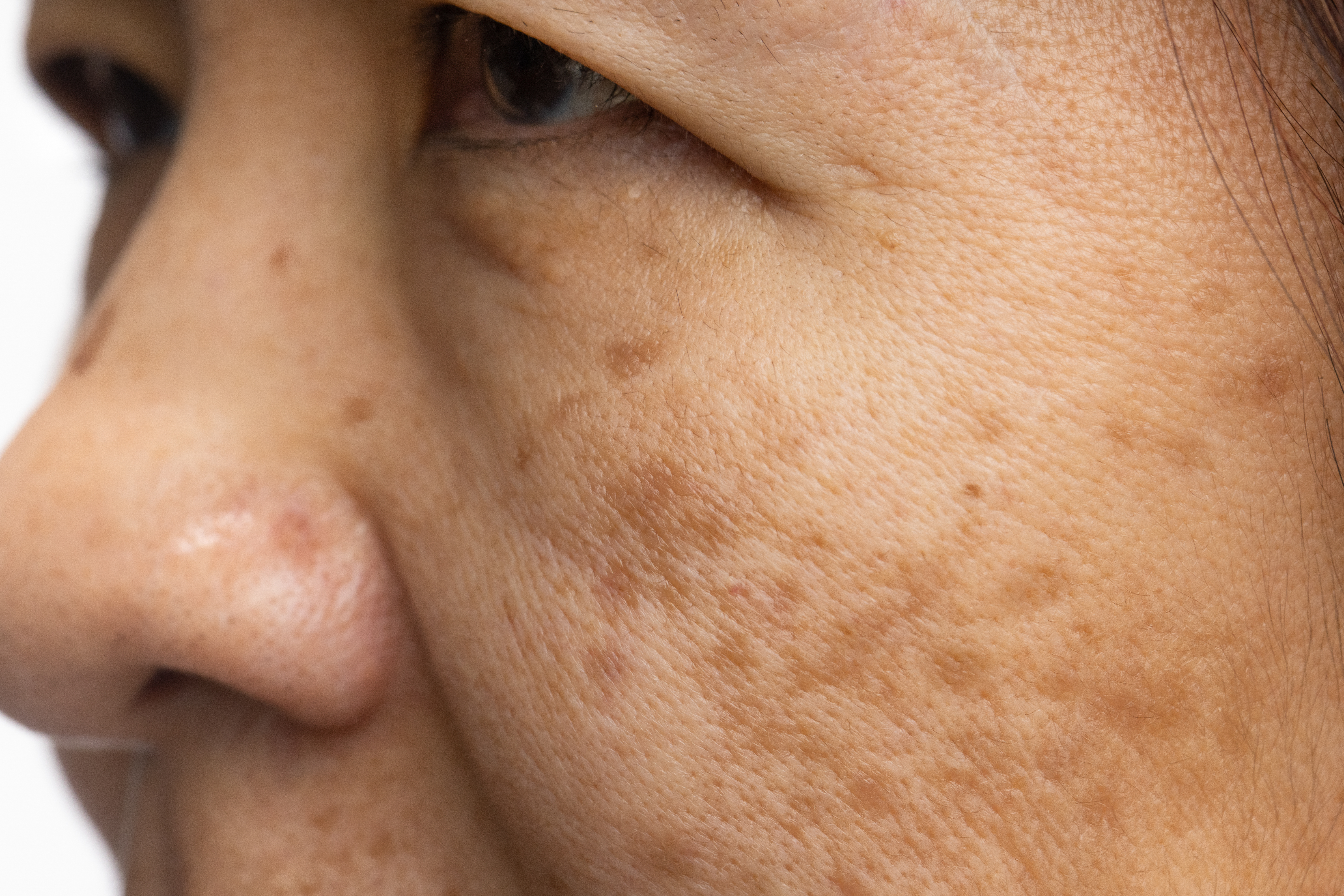 Melasma