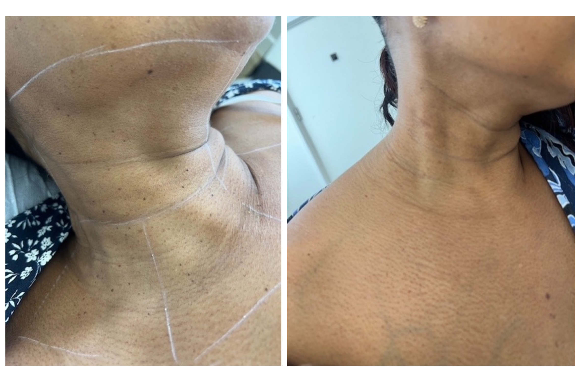Dermatosis papulosa nigra (DPN)
