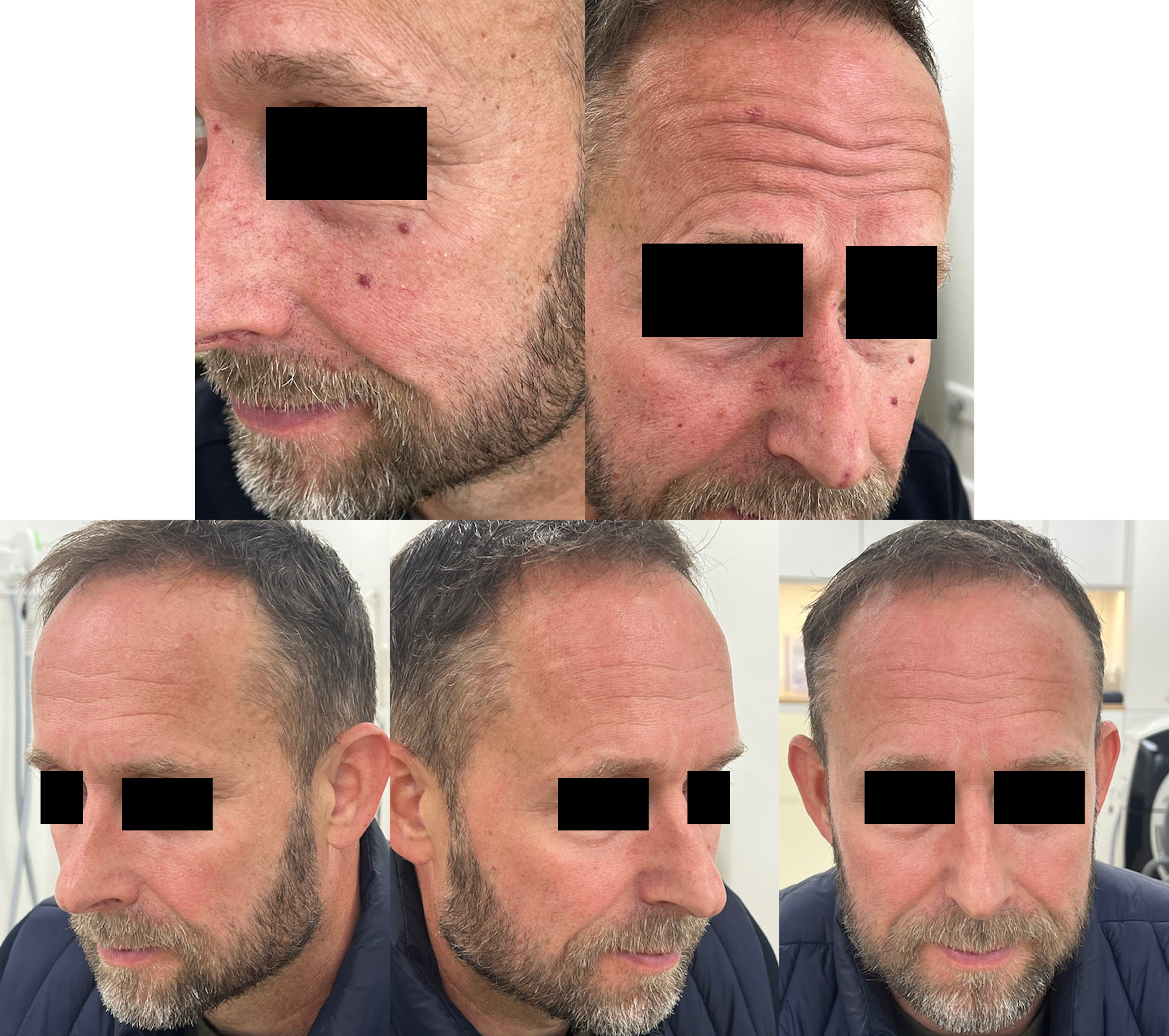 Nd:YAG-laser behandelingen