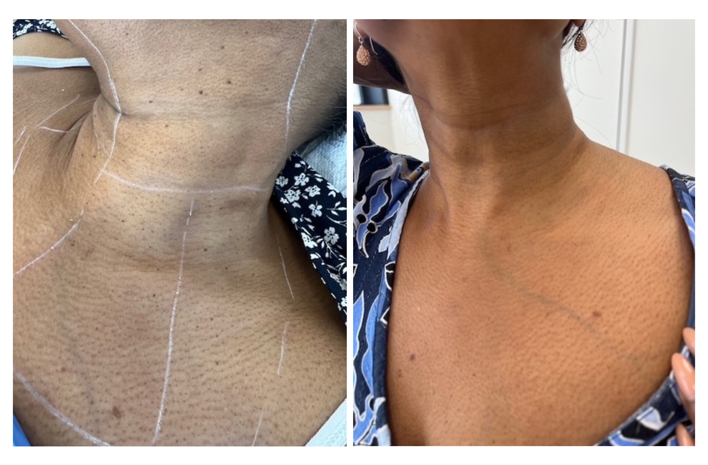 Dermatosis papulosa nigra (DPN)