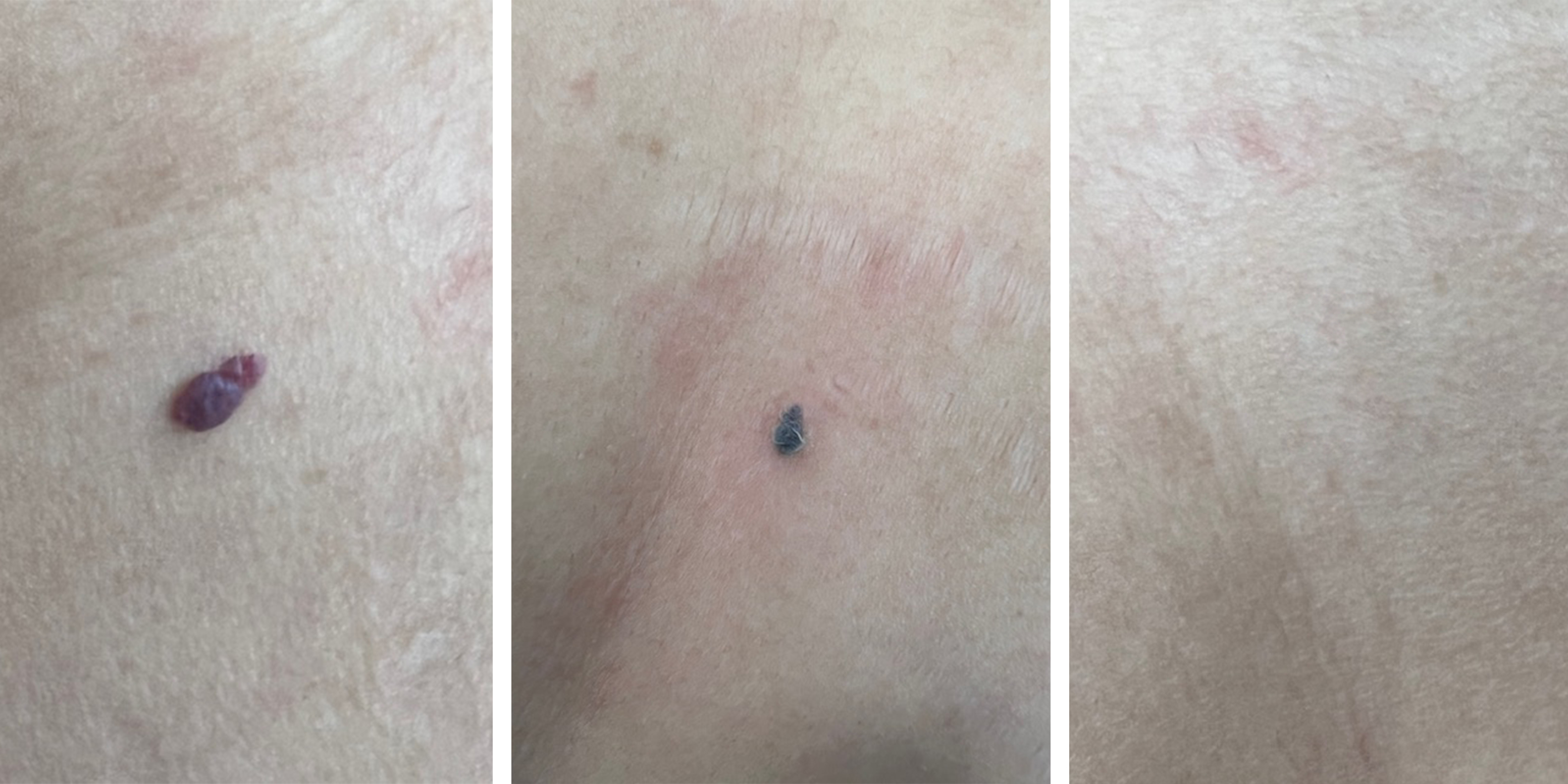 Vaatlaser bij cherry angioma (bloedblaasjes kerstwratjes)