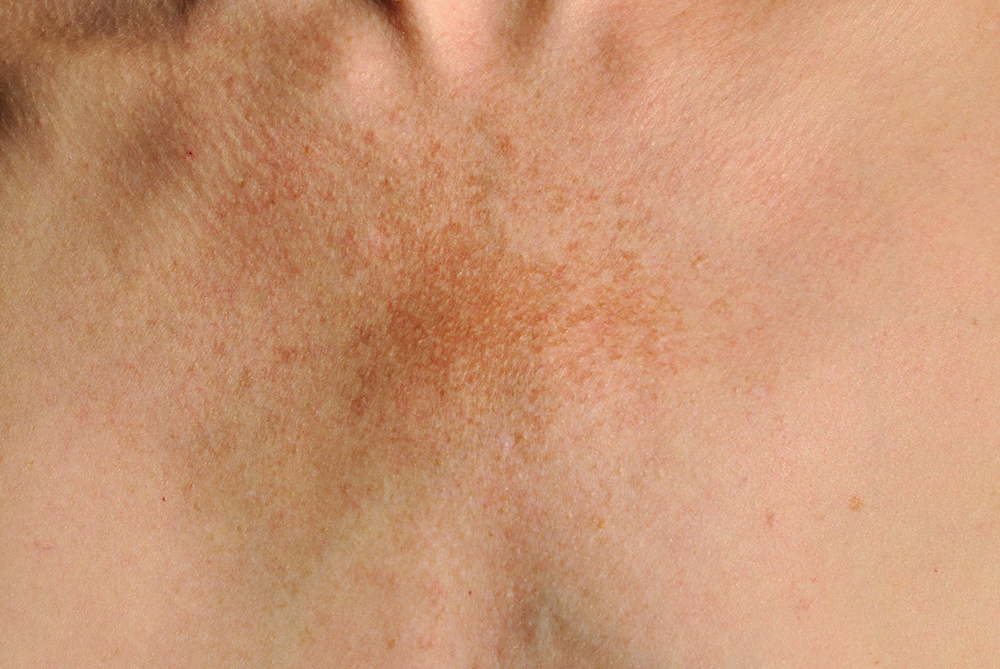 Poikiloderma van Civatte