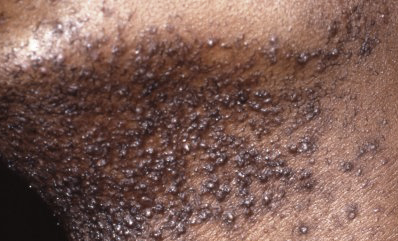 Folliculitis Barbae (Pseudofolliculitis Barbae)