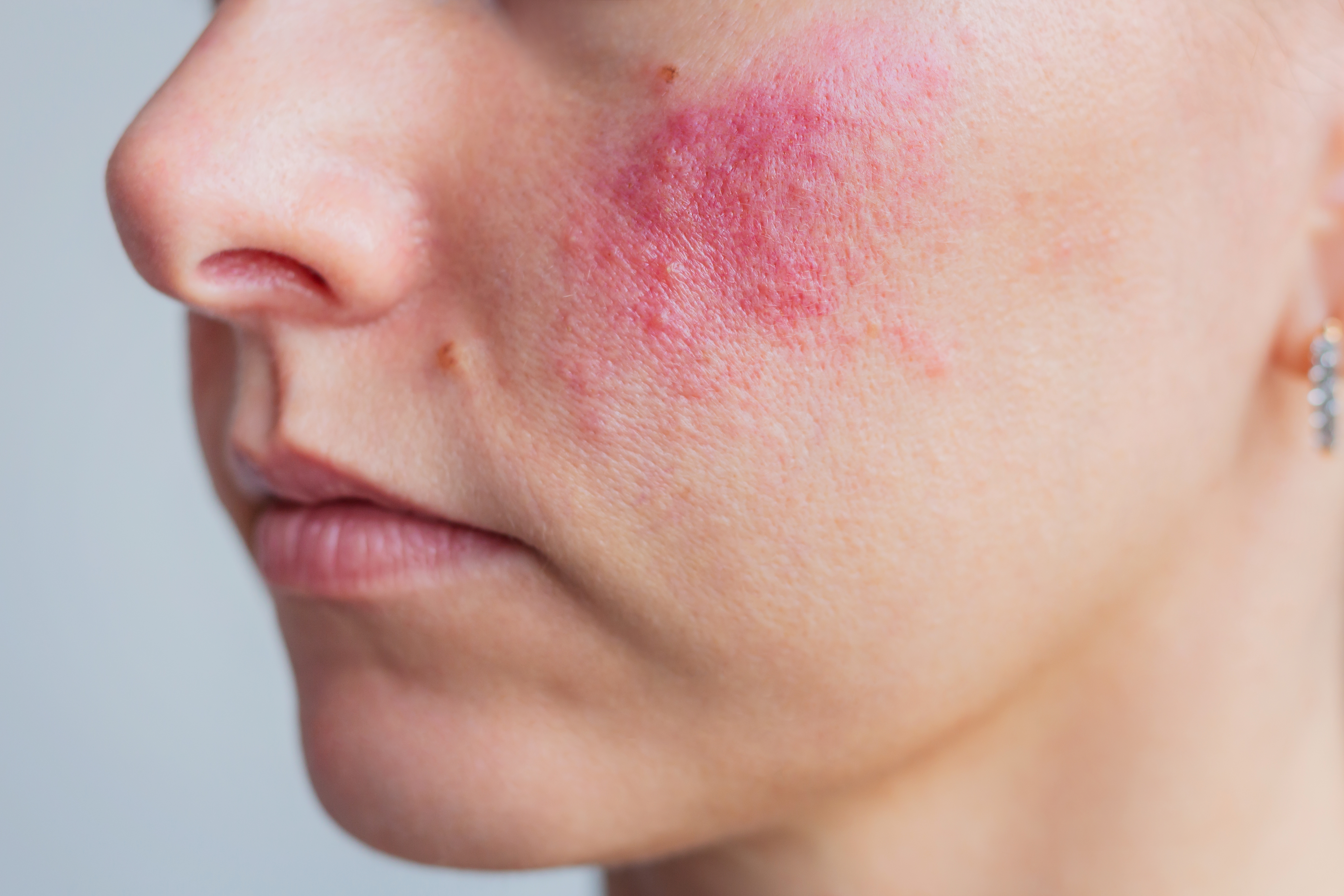 Vaatlaser en IPL bij rosacea