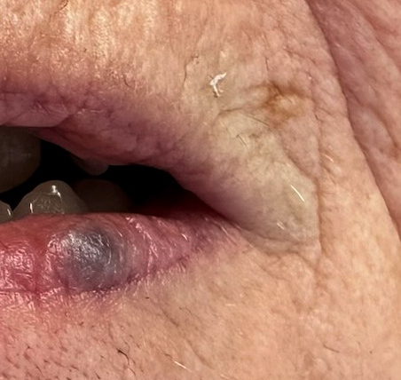 Venous lake (Bloedblaar op de lip) 