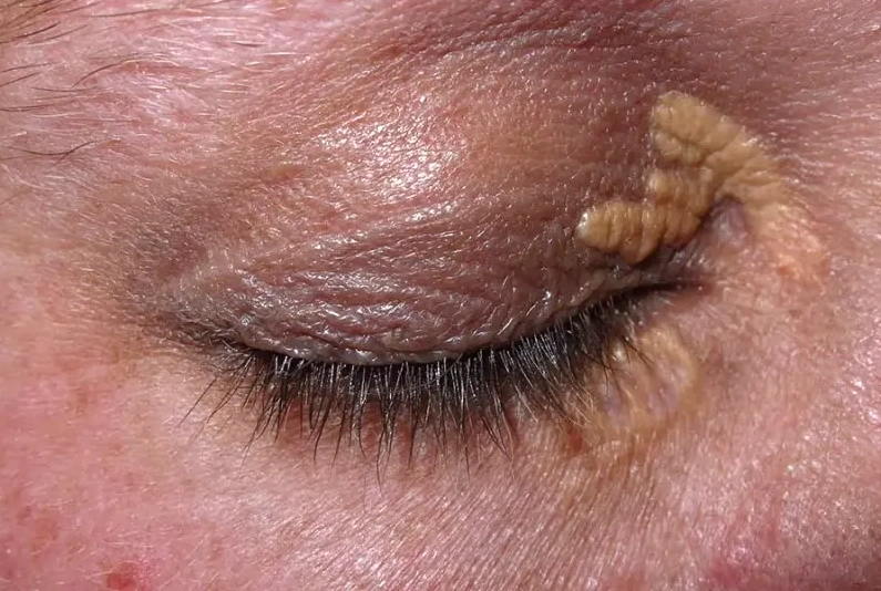 Xanthelasma (Gele bultjes in de ooghoek)