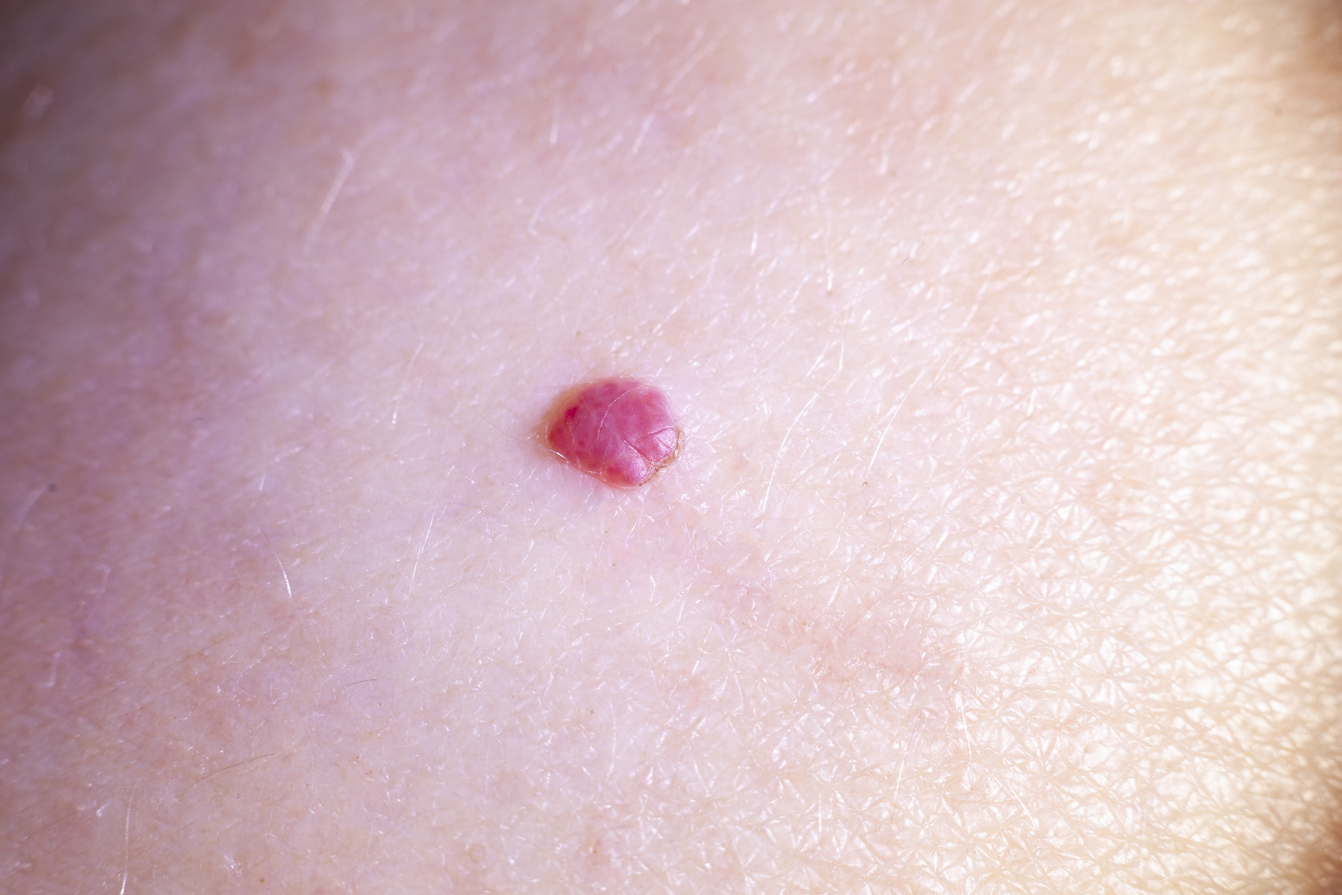 Bloedblaasjes (Cherry angioma)