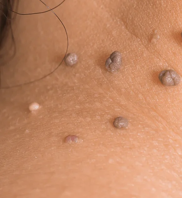 Steelwratjes (Fibromen)