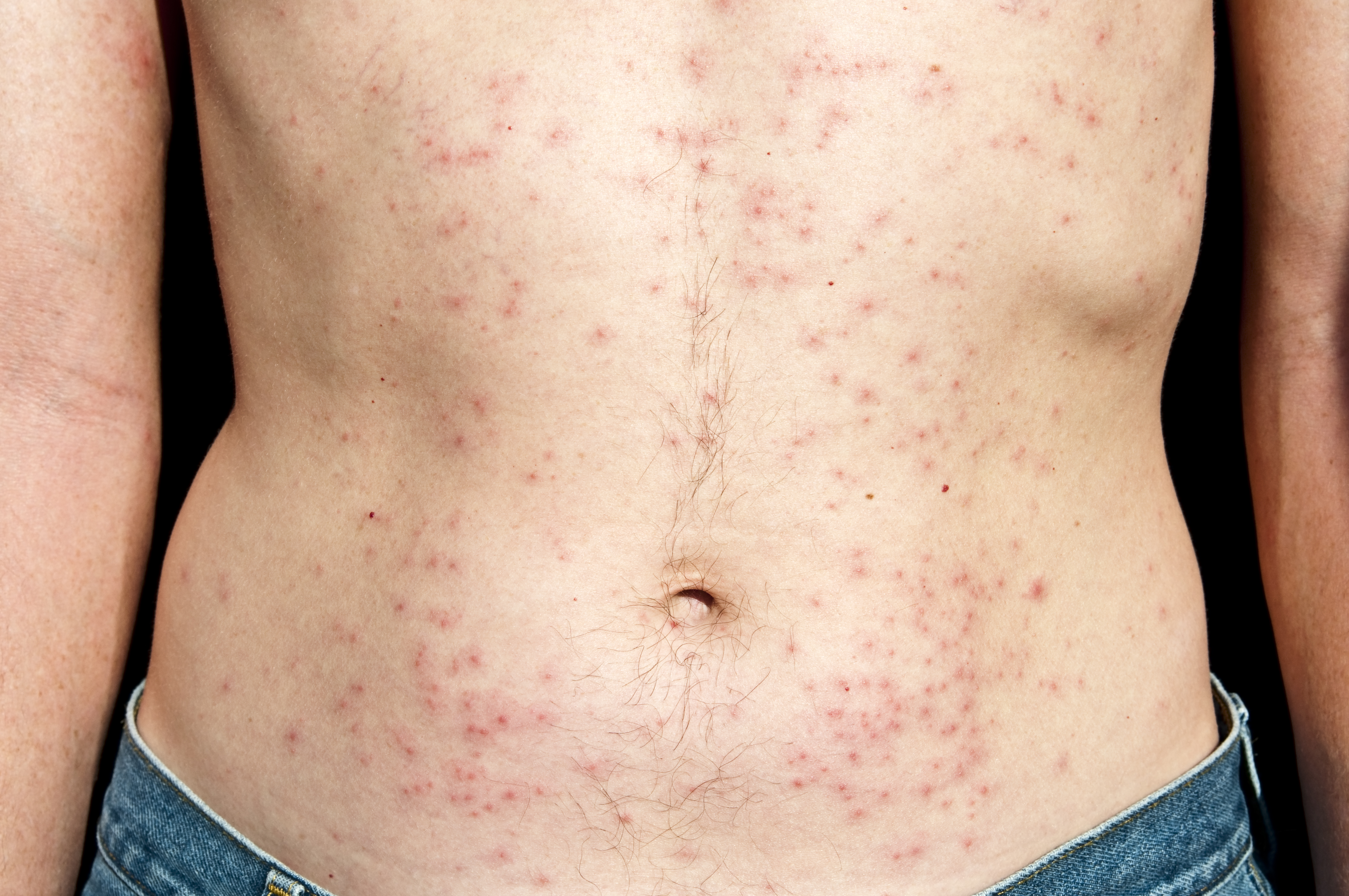Folliculitis – ontstoken haarzakjes