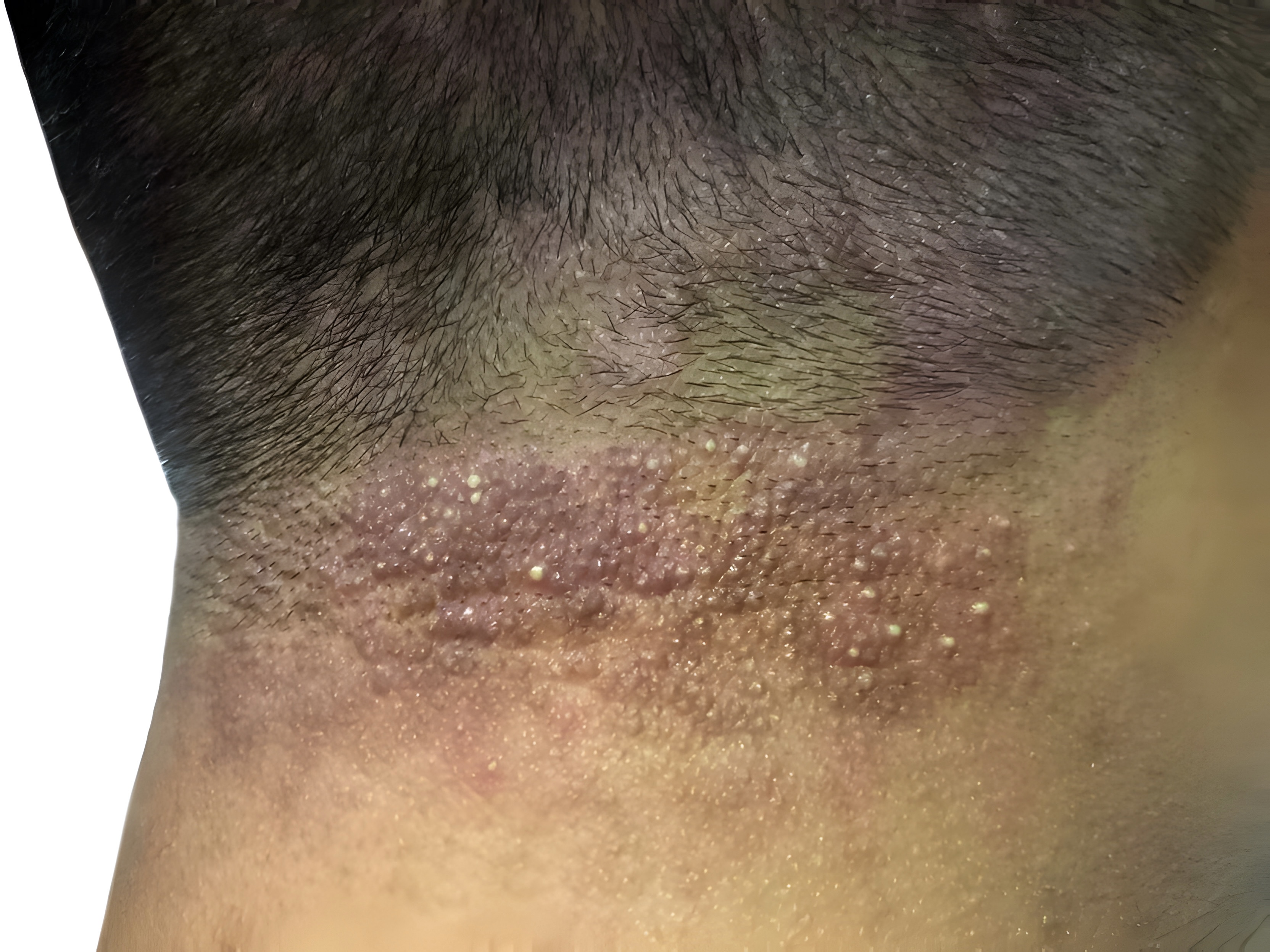 Folliculitis – ontstoken haarzakjes