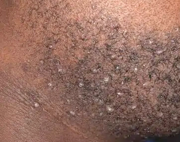 Folliculitis Barbae (Pseudofolliculitis Barbae)